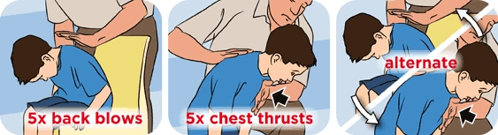 Cha mẹ phải biết cách sơ cứu khi trẻ bị hóc dị vật - 5
