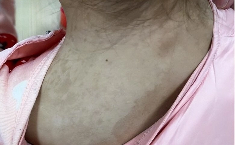 Con gái 5 tuổi có nhiều đốm nâu trên lưng mẹ tưởng là tàn nhang nhưng đến bệnh viện bác sĩ đưa ra kết luận sốc - 2