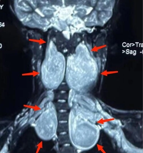 Con gái 5 tuổi có nhiều đốm nâu trên lưng mẹ tưởng là tàn nhang nhưng đến bệnh viện bác sĩ đưa ra kết luận sốc - 3