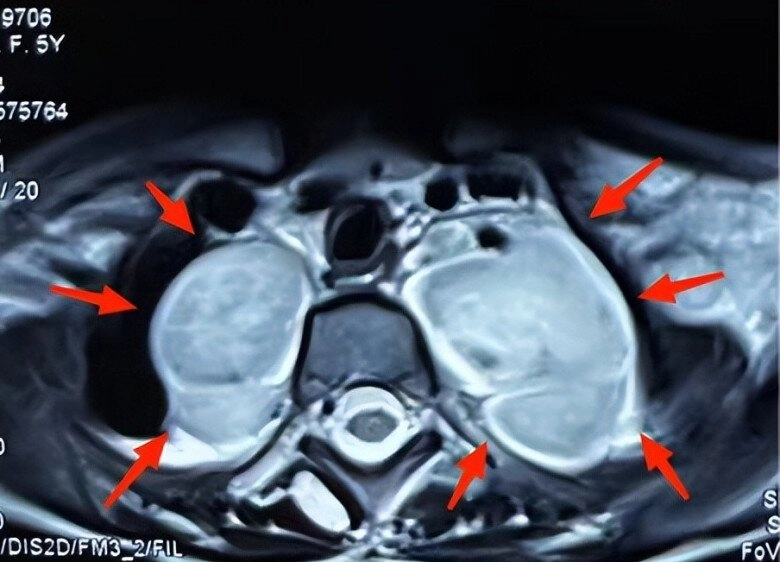 Con gái 5 tuổi có nhiều đốm nâu trên lưng mẹ tưởng là tàn nhang nhưng đến bệnh viện bác sĩ đưa ra kết luận sốc - 4