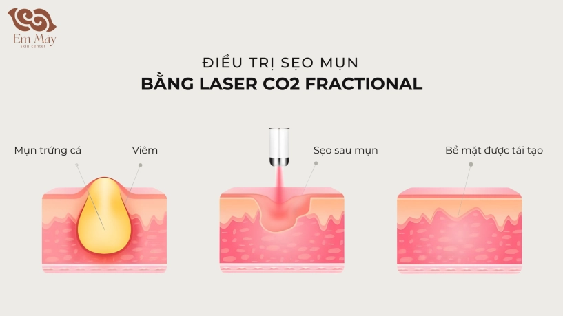 Điều trị sẹo rỗ bằng laser co2 fractional có thực sự hiệu quả góc nhìn từ phòng khám em mây skin center - 2