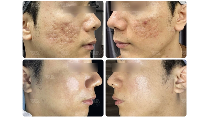 Điều trị sẹo rỗ bằng laser co2 fractional có thực sự hiệu quả góc nhìn từ phòng khám em mây skin center - 3