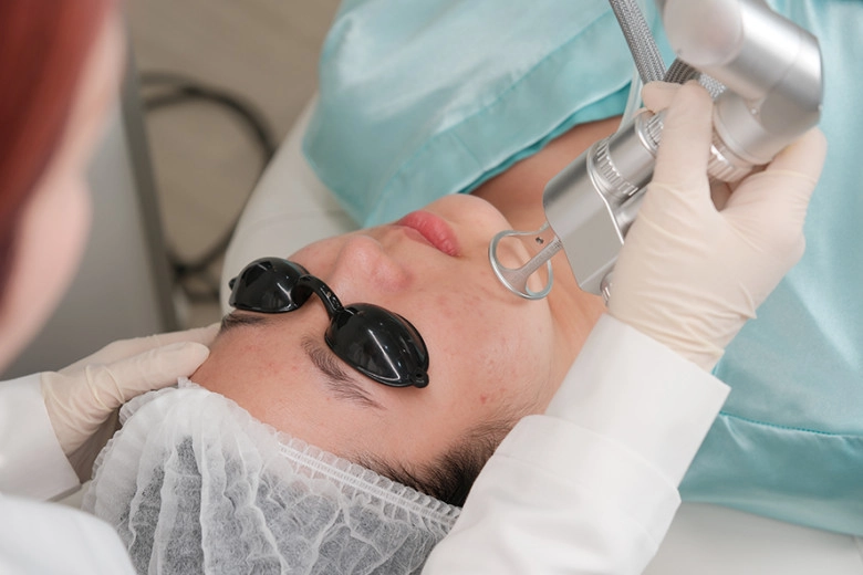 Điều trị sẹo rỗ bằng laser co2 fractional có thực sự hiệu quả góc nhìn từ phòng khám em mây skin center - 5