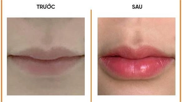 Filler hàn quốc có ưu điểm vượt trội gì - 3