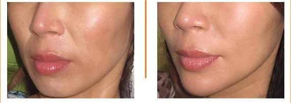 Filler hàn quốc có ưu điểm vượt trội gì - 4