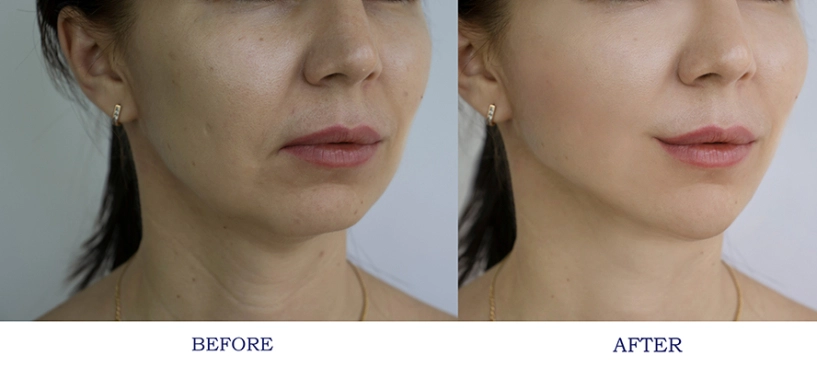 Filler sardenya - bước tiến mới của phụ nữ hiện đại trong hành trình làm đẹp - 3