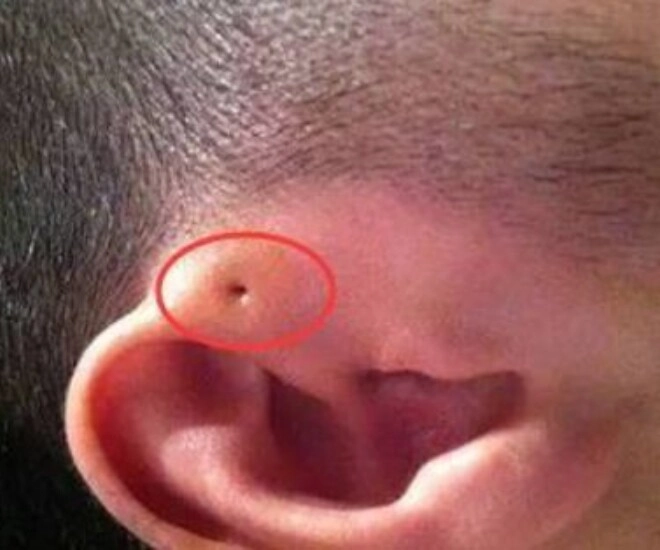 Mẹ phát hiện gần tai con xuất hiện một lỗ sâu khác thường liền tò mò bóp thử không ngờ bác sĩ hét phẫu thuật ngay - 1