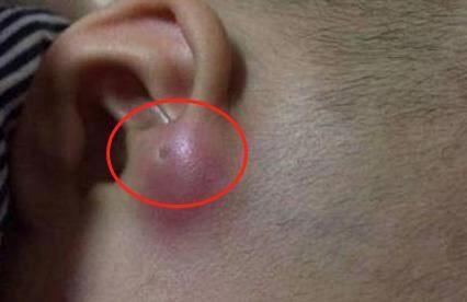 Mẹ phát hiện gần tai con xuất hiện một lỗ sâu khác thường liền tò mò bóp thử không ngờ bác sĩ hét phẫu thuật ngay - 2