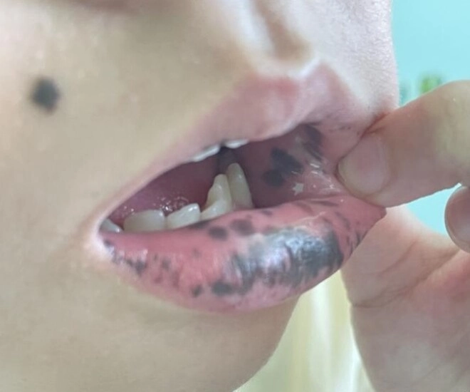 Mẹ phát hiện môi con gái 10 tuổi có nhiều đốm đen kỳ lạ đến bệnh viện kiểm tra thì kinh hãi nghe bác sĩ nói - 1