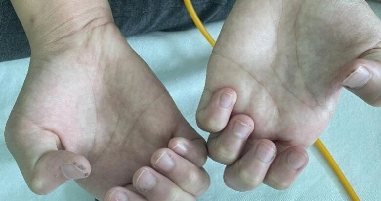 Mẹ phát hiện môi con gái 10 tuổi có nhiều đốm đen kỳ lạ đến bệnh viện kiểm tra thì kinh hãi nghe bác sĩ nói - 2