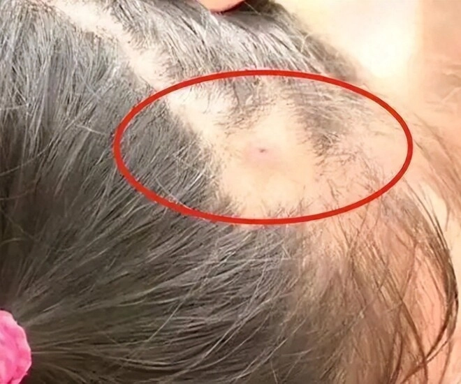 Mẹ phát hiện trên đầu con xuất hiện một lỗ sâu kỳ lạ liền đưa đi khám đến bệnh viện bác sĩ nói đứa trẻ quá may mắn - 1