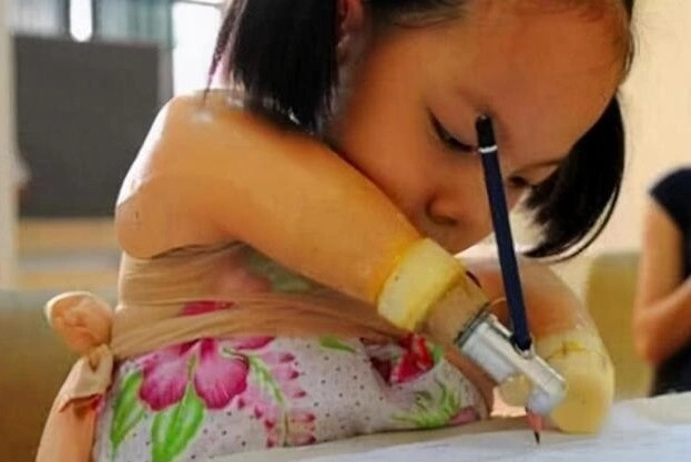 Mẹ quyết sinh con không có taychân dù gia đình nội chối bỏ đứa trẻ càng lớn càng xinh như thiên thần - 3