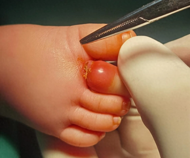 Bé trai 3 tháng tuổi suýt mất 1 ngón chân khi ngủ dậy nghe bác sĩ nói phẫu thuật gấp người mẹ ngập trong nước mắt - 1