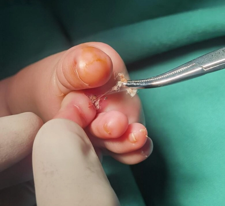 Bé trai 3 tháng tuổi suýt mất 1 ngón chân khi ngủ dậy nghe bác sĩ nói phẫu thuật gấp người mẹ ngập trong nước mắt - 2