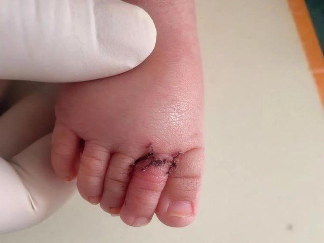 Bé trai 3 tháng tuổi suýt mất 1 ngón chân khi ngủ dậy nghe bác sĩ nói phẫu thuật gấp người mẹ ngập trong nước mắt - 3