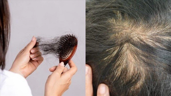 Càng ăn nhiều 2 thứ này tóc càng rụng tơi tả sau vài năm trông già đi nhanh vì hói đầu - 1