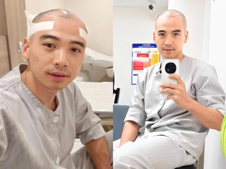 Chồng hhen niê nỗ lực thay đổi ngoại hình từ khi cưới vợ hoa hậu hết phẫu thuật cấy tóc đến nhờ ai giúp giảm cân - 6
