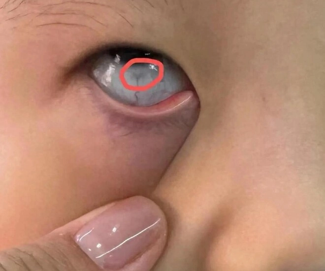 Con trai 10 tuổi mắt sưng húp liên tục kêu ngứa đưa đến bệnh viện khám mẹ thất kinh khi thấy vật thể lạ bên trong - 1