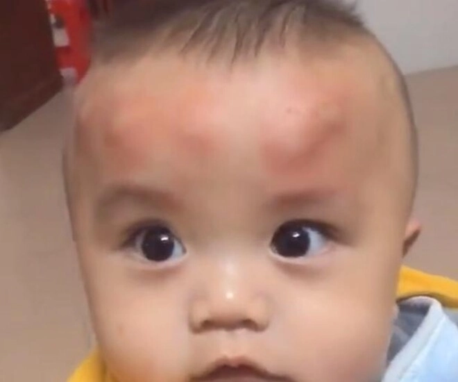 Con trai 2 tuổi ngủ dậy trên đầu liền xuất hiện nhiều khối u bất thường người mẹ tá hoả khi biết nguyên nhân - 1
