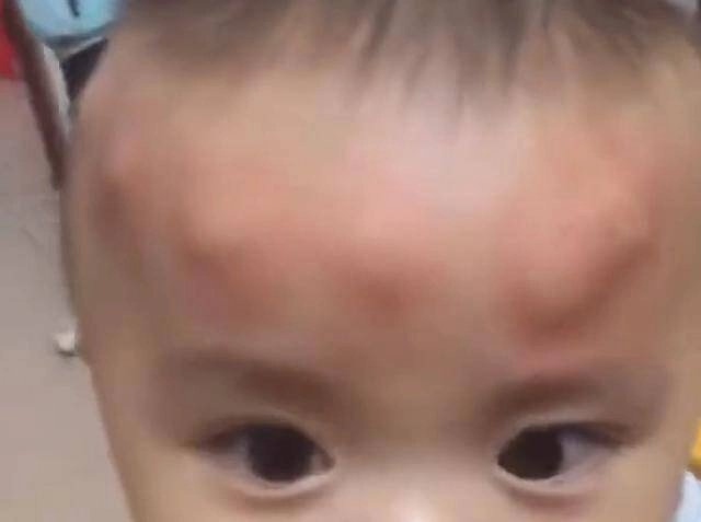 Con trai 2 tuổi ngủ dậy trên đầu liền xuất hiện nhiều khối u bất thường người mẹ tá hoả khi biết nguyên nhân - 2