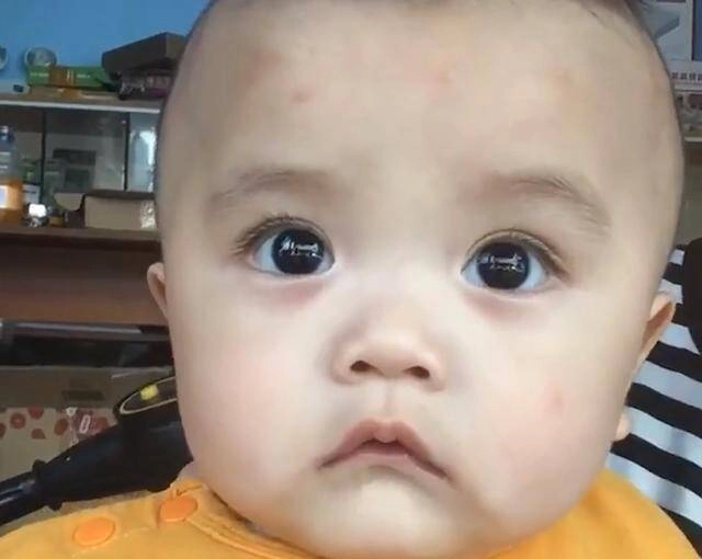 Con trai 2 tuổi ngủ dậy trên đầu liền xuất hiện nhiều khối u bất thường người mẹ tá hoả khi biết nguyên nhân - 4