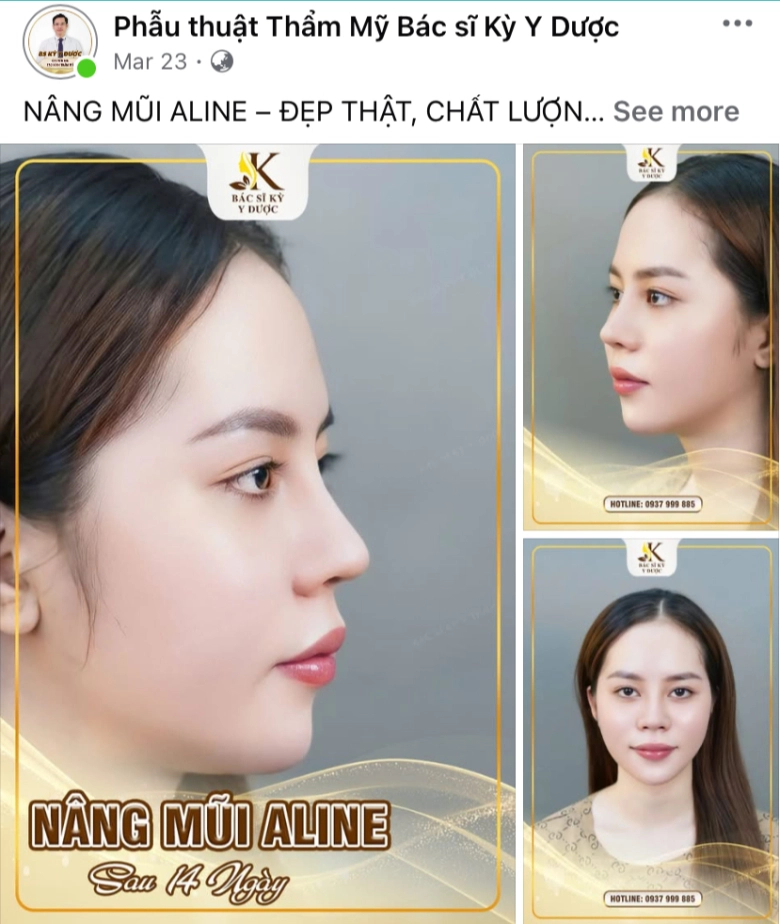 Dáng mũi aline chuẩn từng milimet từ bác sĩ kỳ y dược - 3