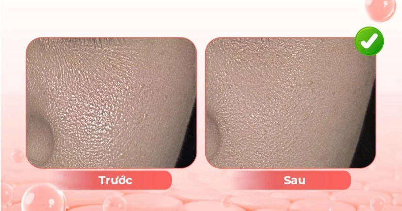 Điều trị lão hóa sắc tố da tuổi trung niên - 1
