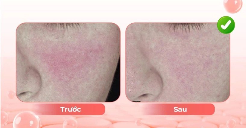 Điều trị lão hóa sắc tố da tuổi trung niên - 2