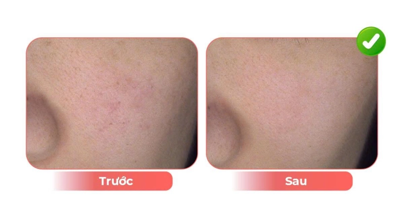 Điều trị lão hóa sắc tố da tuổi trung niên - 3