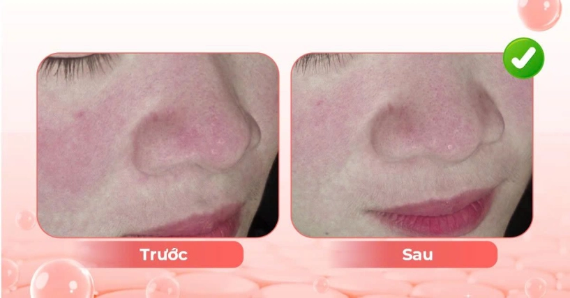 Điều trị lão hóa sắc tố da tuổi trung niên - 4