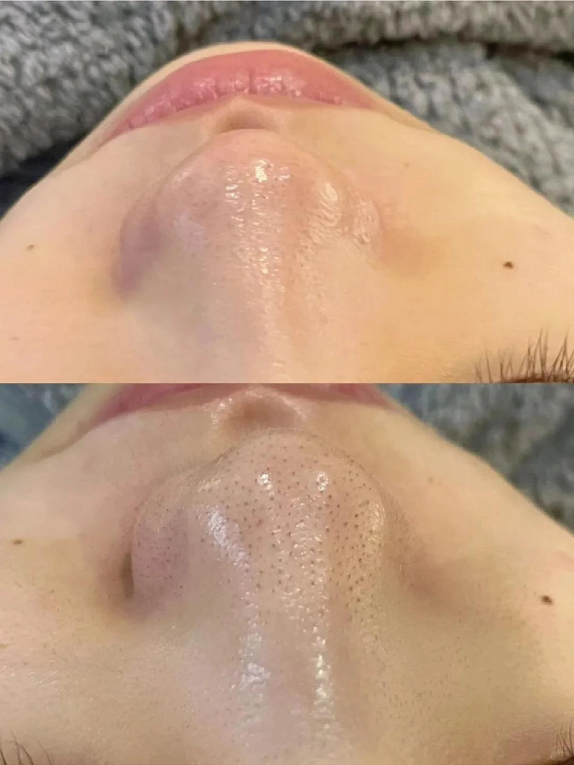 Làm sạch da kỹ lưỡng nhưng vẫn mụn đầu đen vẫn xuất hiện có phải vì dùng sai loại sữa rửa mặt - 4