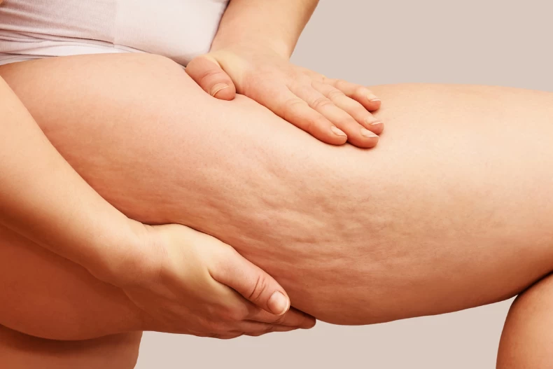 Mất tự tin vì da sần vỏ cam 4 cách khắc phục đơn giản tại nhà giúp chị em tự tin diện đồ đẹp - 1
