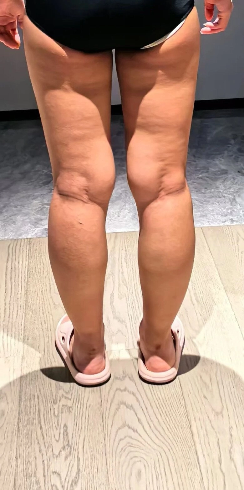 Mất tự tin vì da sần vỏ cam 4 cách khắc phục đơn giản tại nhà giúp chị em tự tin diện đồ đẹp - 3