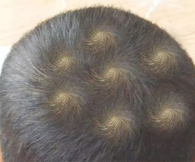 Mẹ phát hiện trên đầu con xuất hiện 7 vòng xoáy kỳ lạ lo lắng đưa đến viện khám bác sĩ thốt lên thật hiếm gặp - 1