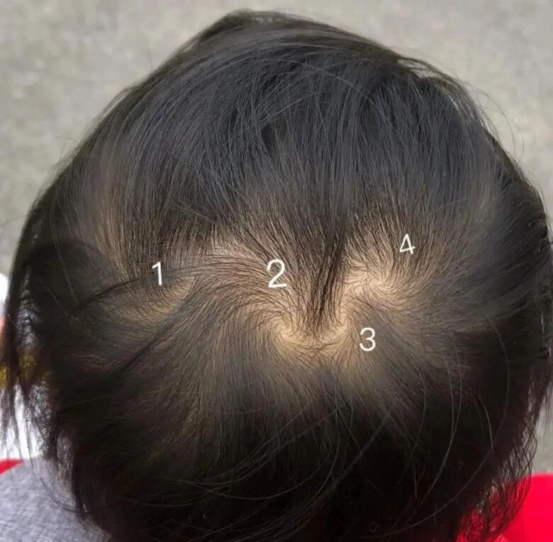 Mẹ phát hiện trên đầu con xuất hiện 7 vòng xoáy kỳ lạ lo lắng đưa đến viện khám bác sĩ thốt lên thật hiếm gặp - 3