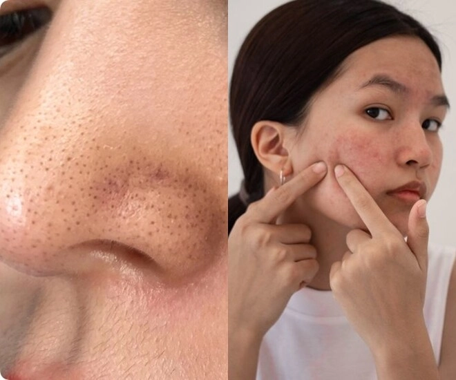 Muốn trị dứt điểm mụn đầu đen tránh xa 3 thực phẩm này nếu không muốn công sức skincare đổ sông đổ biển - 1