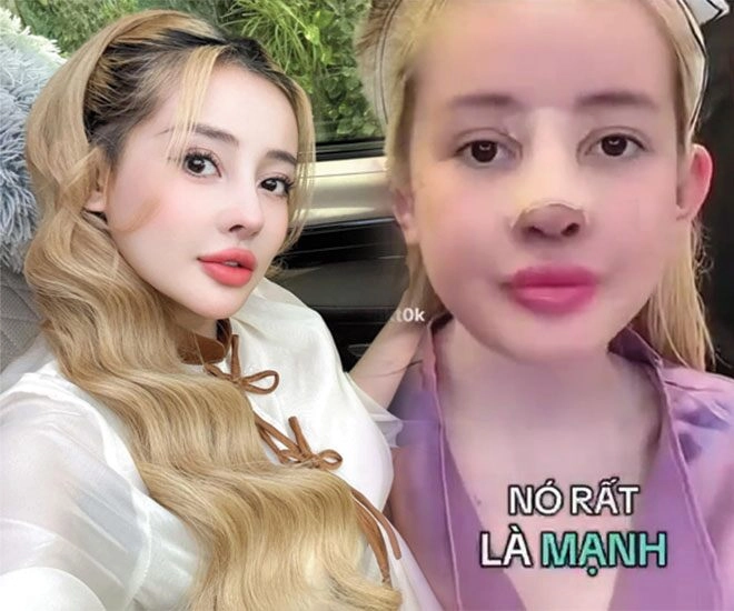 Ngân 98 ngất xỉu khi tháo sụn mũi giả sau 12 lần sửa giờ phải lấy mỡ từ mông để cấy lên mũi - 1