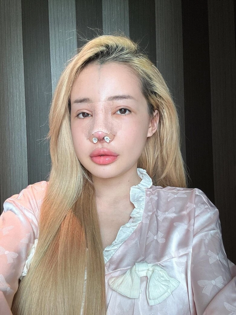 Ngân 98 ngất xỉu khi tháo sụn mũi giả sau 12 lần sửa giờ phải lấy mỡ từ mông để cấy lên mũi - 3