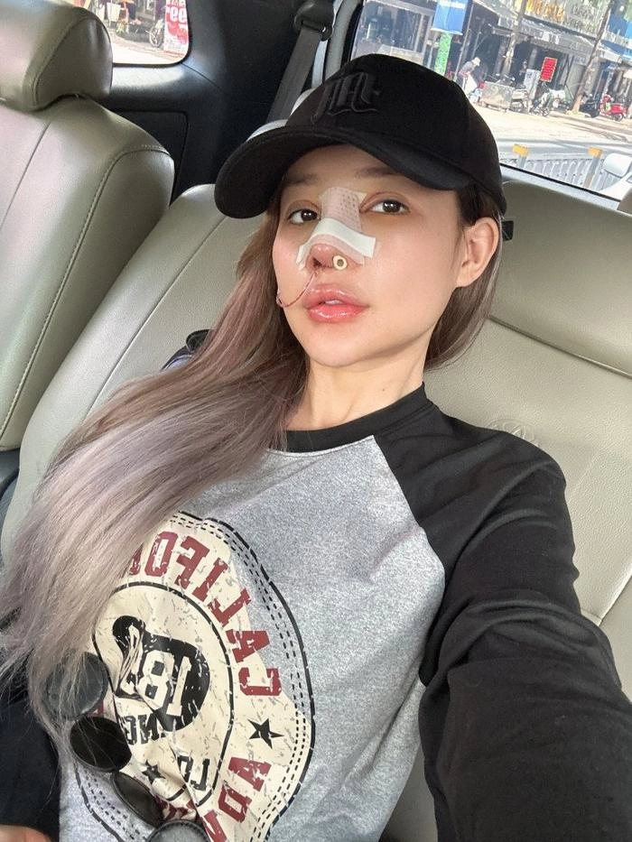 Ngân 98 ngất xỉu khi tháo sụn mũi giả sau 12 lần sửa giờ phải lấy mỡ từ mông để cấy lên mũi - 6