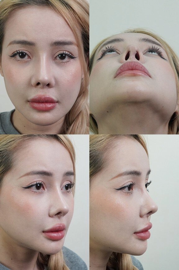 Ngân 98 ngất xỉu khi tháo sụn mũi giả sau 12 lần sửa giờ phải lấy mỡ từ mông để cấy lên mũi - 7