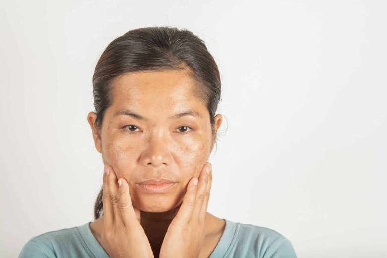 Những thành phần dưỡng da gặp trời nắng liền phản chủ càng dùng càng làm da bị kích ứng nặng - 8