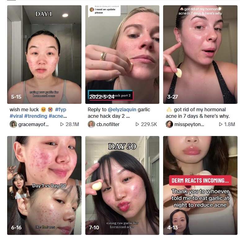 Phương pháp trị mụn bằng tỏi hot trên tiktok có thực sự hiệu quả hay hại da bác sĩ da liễu chỉ cách làm đúng nhất - 1