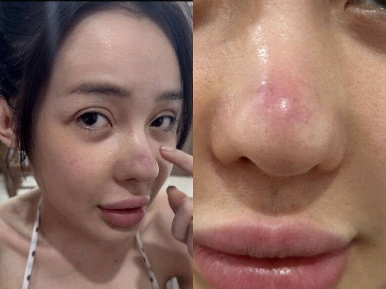 Sau 12 lần phẫu thuật thẩm mỹ rồi bị co rút mũi ngân 98 lại tiếp tục gặp biến khiến dân tình tá hoả - 2