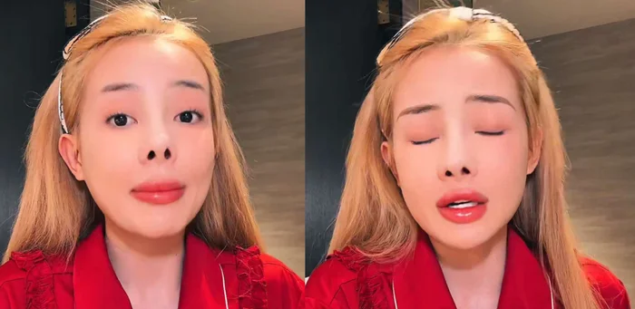 Sau 12 lần phẫu thuật thẩm mỹ rồi bị co rút mũi ngân 98 lại tiếp tục gặp biến khiến dân tình tá hoả - 6
