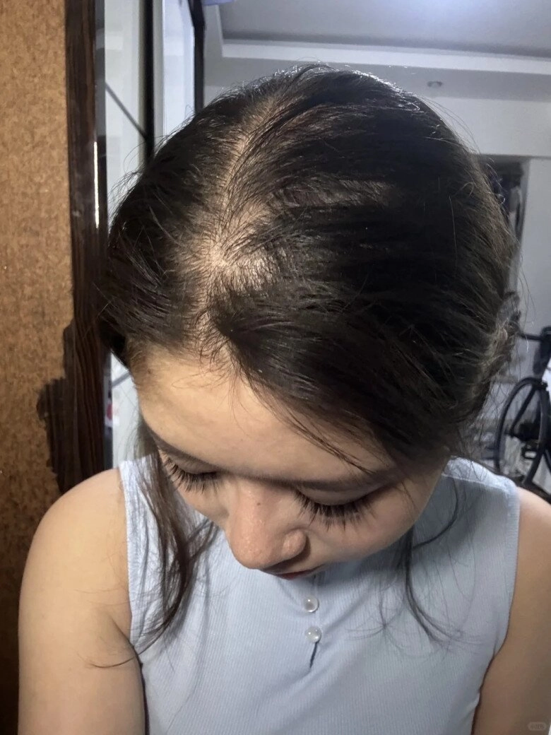 Tại sao tóc rụng không ngừng ngày càng mỏng mách nàng 5 cách khắc phục rụng tóc hiệu quả cho mái tóc dày đẹp - 1