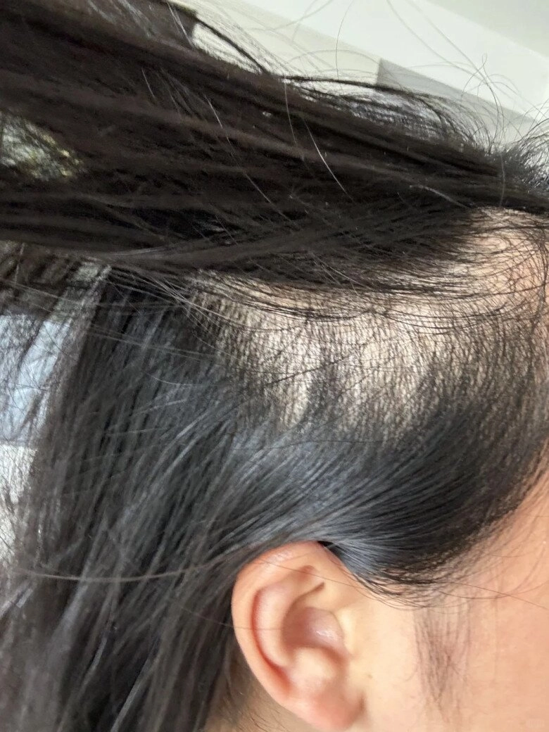 Tại sao tóc rụng không ngừng ngày càng mỏng mách nàng 5 cách khắc phục rụng tóc hiệu quả cho mái tóc dày đẹp - 2