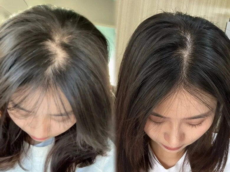 Tại sao tóc rụng không ngừng ngày càng mỏng mách nàng 5 cách khắc phục rụng tóc hiệu quả cho mái tóc dày đẹp - 5