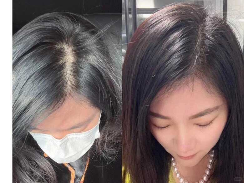 Tóc rụng thưa sắp hói chị em 40 áp dụng 5 phương pháp đơn giản này để đảo ngược tình trạng - 1