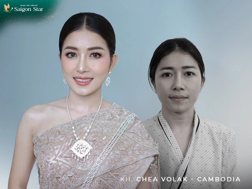 Từ xa trở về việt kiều tin chọn làm đẹp tại saigon star cùng bác sĩ nguyễn hữu hoạt - 3