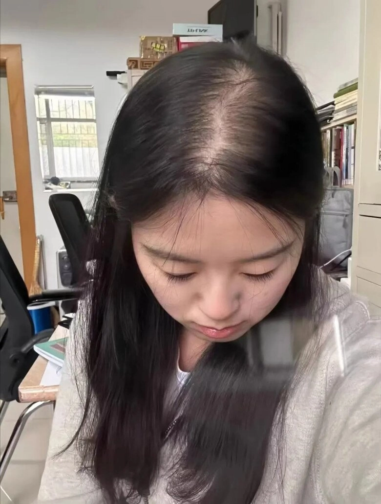 Đừng để tóc rụng không phanh vì lười gội đầu 5 dấu hiệu mái tóc đang gào thét vì gội quá ít - 2